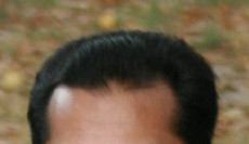 hair_growth_frontal